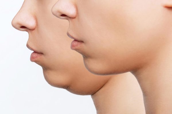 liposuction-double-chin-woman-face-with-chin-before-after-cosmetic-plastic-surgery-profile(1)
